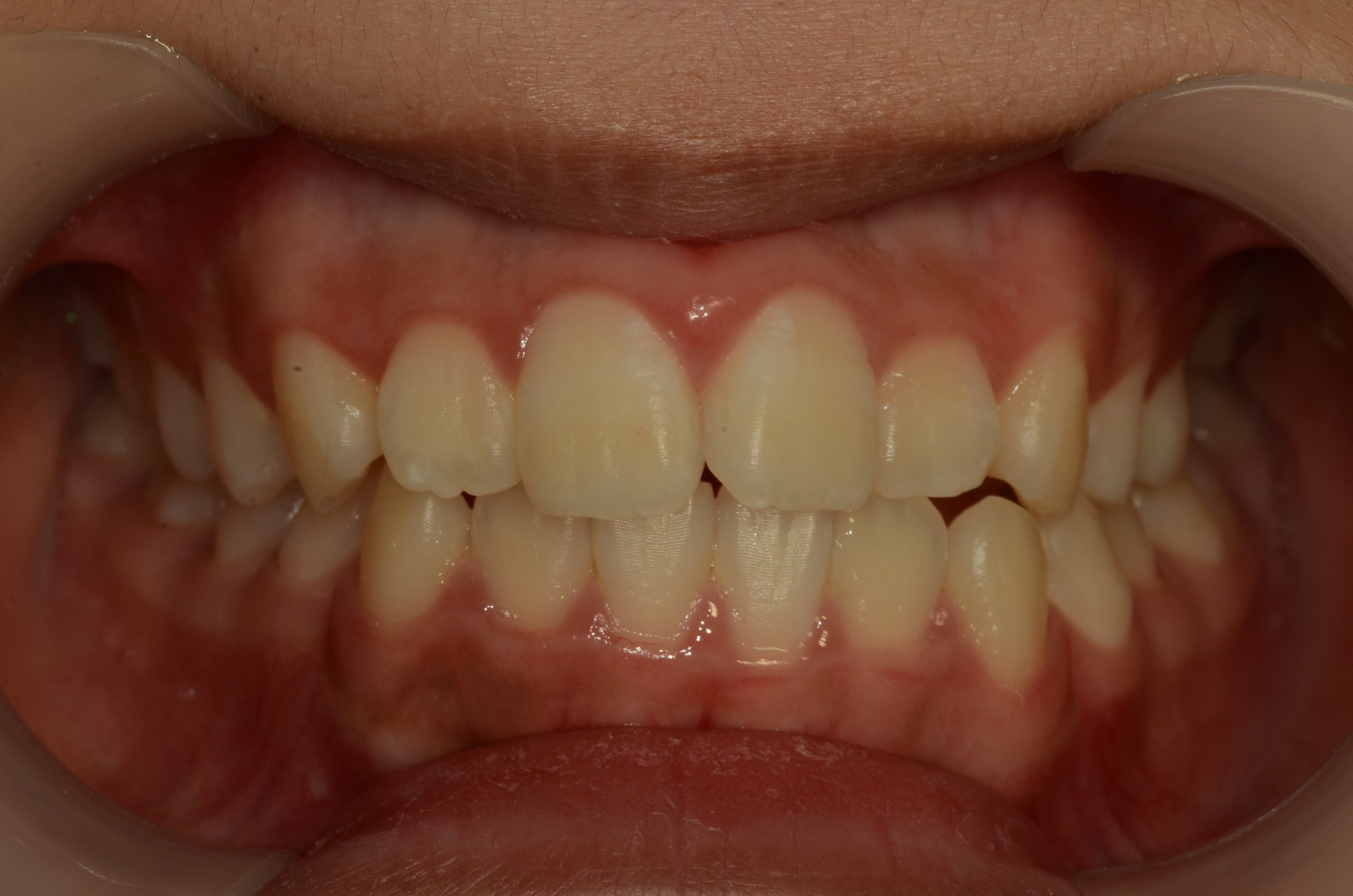 Before