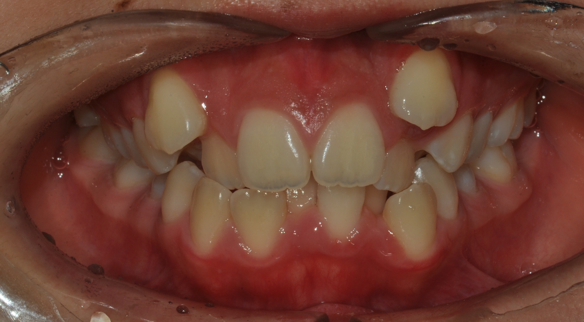 Before