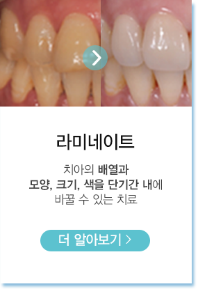 라미네이트